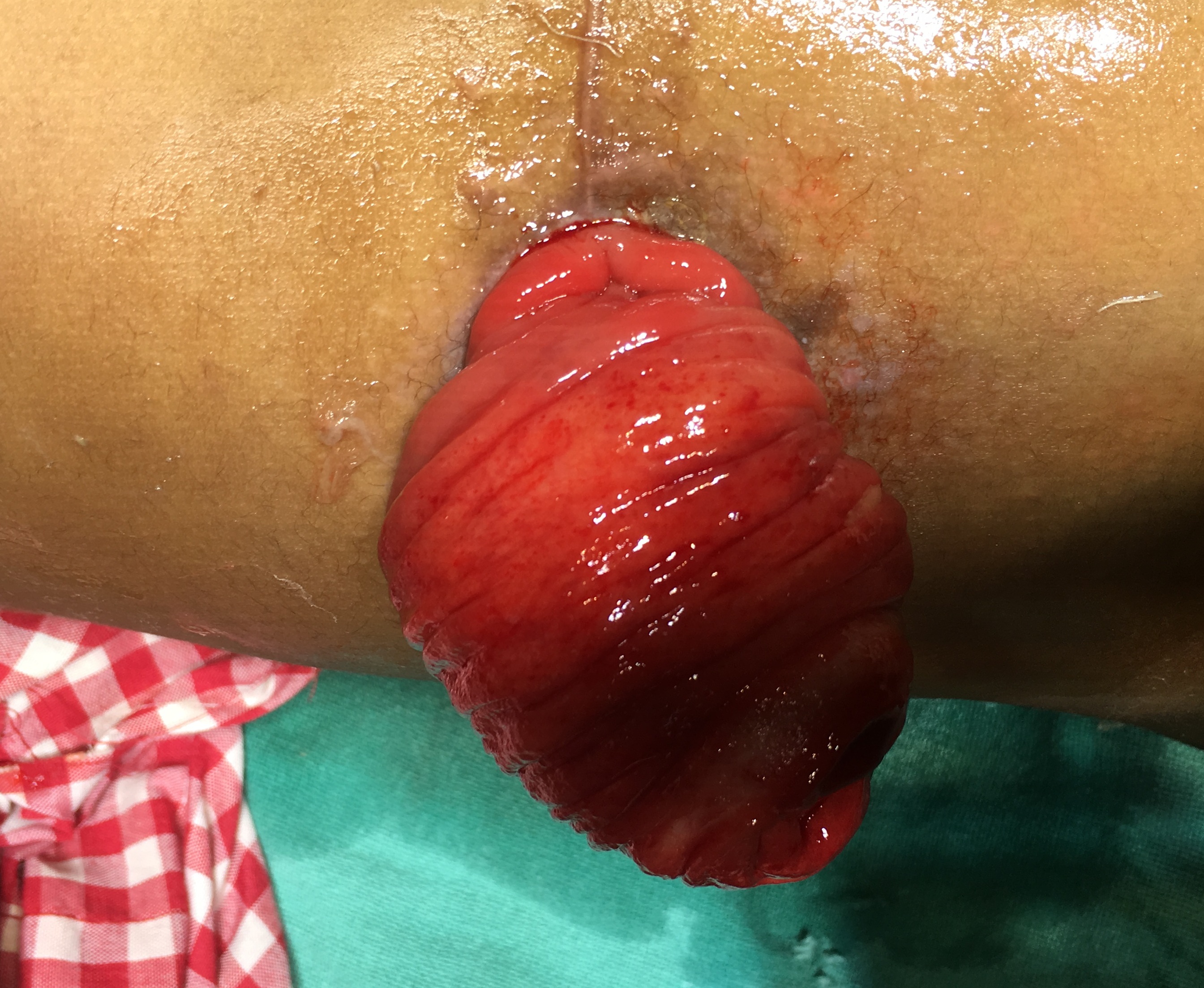 Pediatric G.I. Surgery Image 1